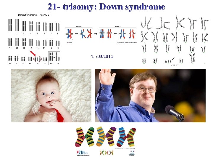 21 - trisomy: Down syndrome 21/03/2014 