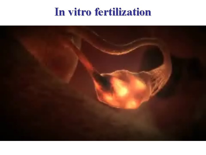 In vitro fertilization 