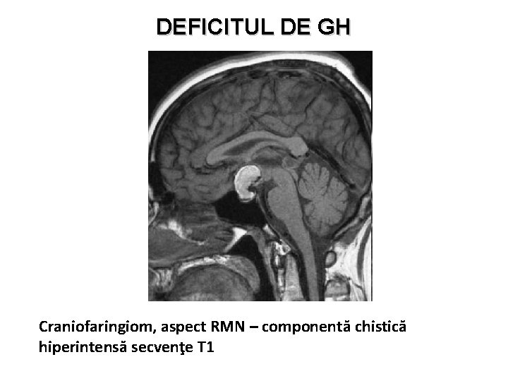 DEFICITUL DE GH Craniofaringiom, aspect RMN – componentă chistică hiperintensă secvenţe T 1 