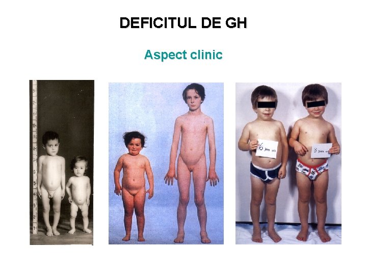 DEFICITUL DE GH Aspect clinic 