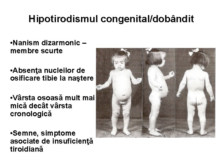 Hipotirodismul congenital/dobândit • Nanism dizarmonic – membre scurte • Absenţa nucleilor de osificare tibie