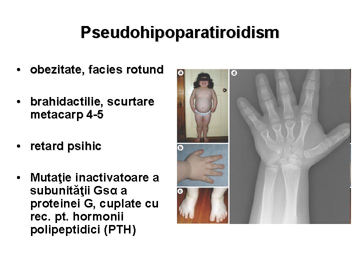 Pseudohipoparatiroidism • obezitate, facies rotund • brahidactilie, scurtare metacarp 4 -5 • retard psihic