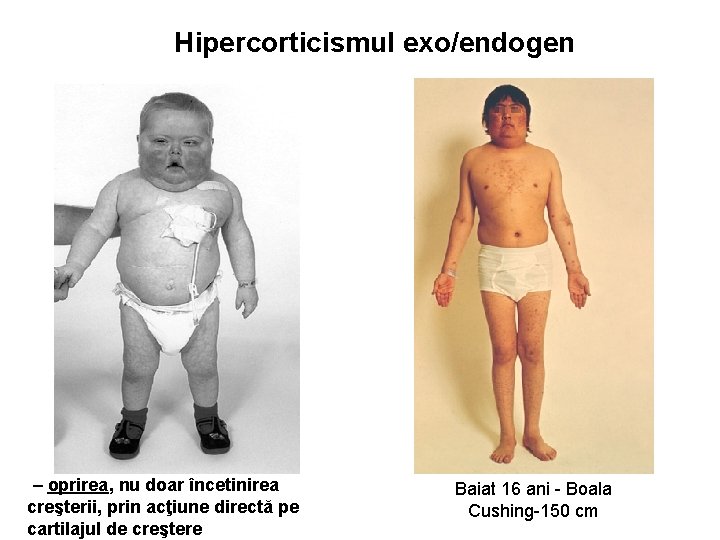 Hipercorticismul exo/endogen – oprirea, nu doar încetinirea creşterii, prin acţiune directă pe cartilajul de