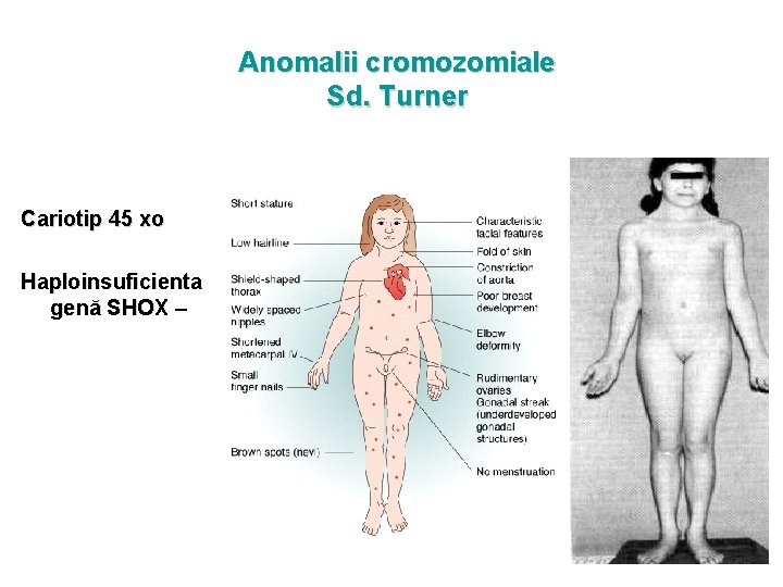 Anomalii cromozomiale Sd. Turner Cariotip 45 xo Haploinsuficienta genă SHOX – 