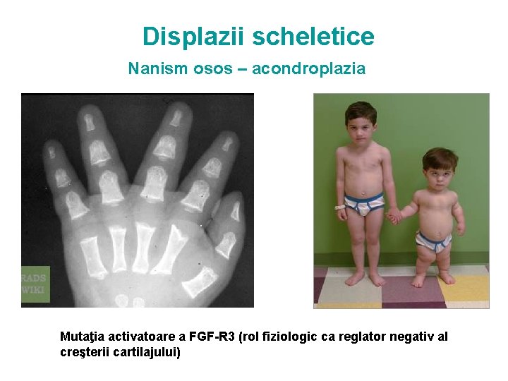 Displazii scheletice Nanism osos – acondroplazia Mutaţia activatoare a FGF-R 3 (rol fiziologic ca