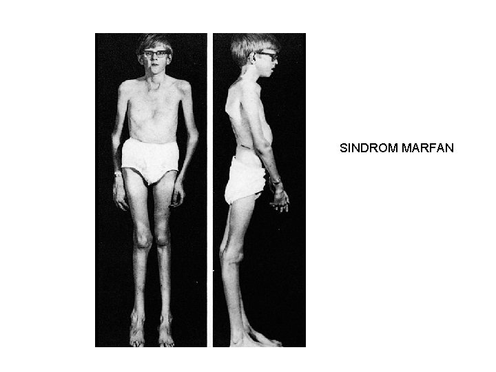 SINDROM MARFAN 