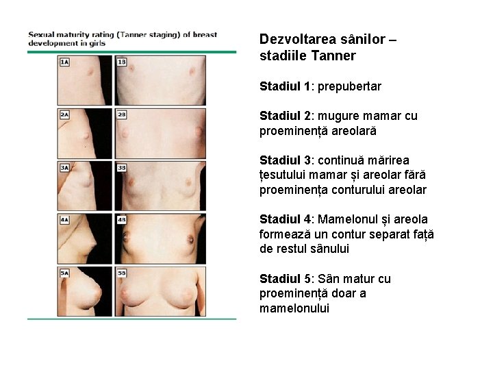 Dezvoltarea sânilor – stadiile Tanner Stadiul 1: prepubertar Stadiul 2: mugure mamar cu proeminență