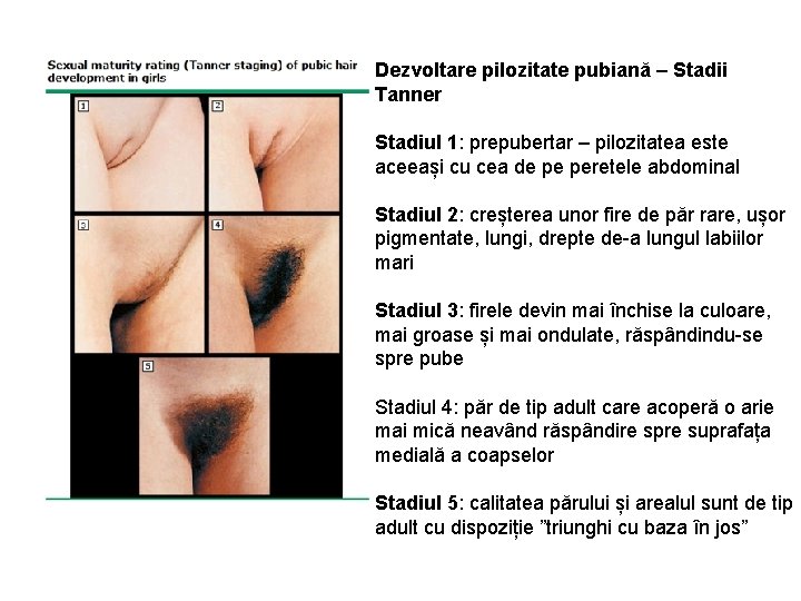 Dezvoltare pilozitate pubiană – Stadii Tanner Stadiul 1: prepubertar – pilozitatea este aceeași cu