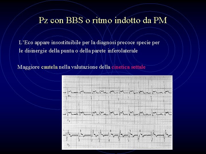 Pz con BBS o ritmo indotto da PM L’Eco appare insostituibile per la diagnosi