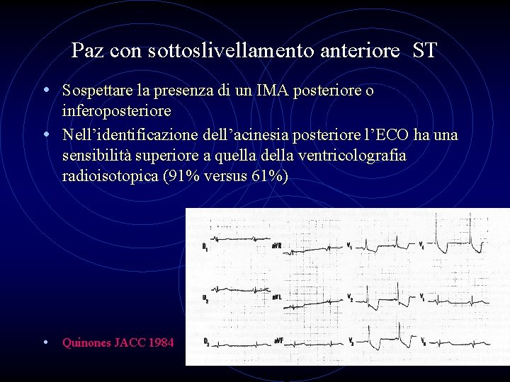 Paz con sottoslivellamento anteriore ST • Sospettare la presenza di un IMA posteriore o