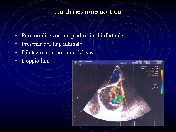 La dissezione aortica • • Può esordire con un quadro simil infartuale Presenza del