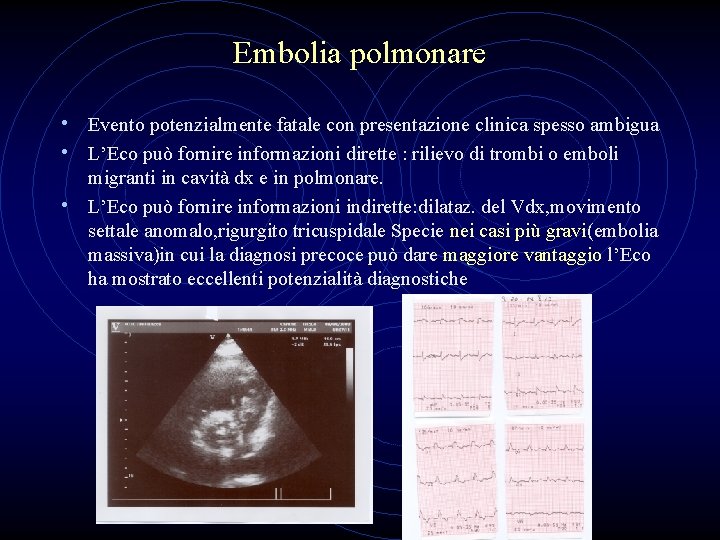 Embolia polmonare • Evento potenzialmente fatale con presentazione clinica spesso ambigua • L’Eco può