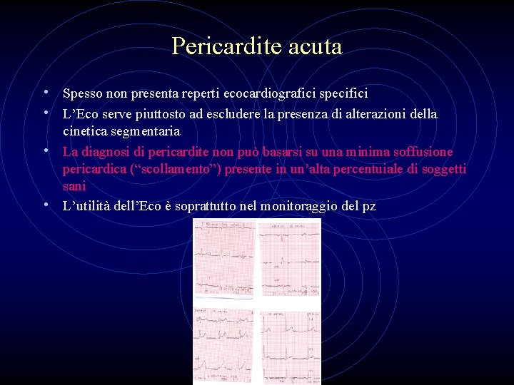 Pericardite acuta • Spesso non presenta reperti ecocardiografici specifici • L’Eco serve piuttosto ad