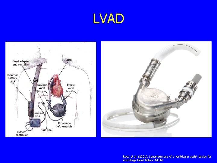 LVAD Rose et al. (2001). Long-term use of a ventricular assist device for end