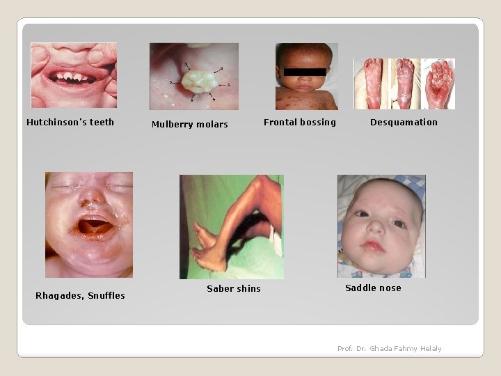 Hutchinson’s teeth Rhagades, Snuffles Mulberry molars Saber shins Frontal bossing Desquamation Saddle nose Prof.