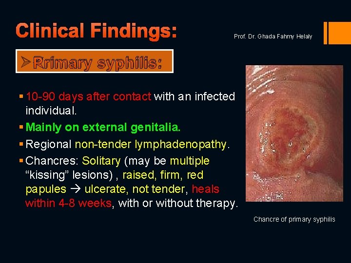 Clinical Findings: Prof. Dr. Ghada Fahmy Helaly Ø Primary syphilis: § 10 -90 days
