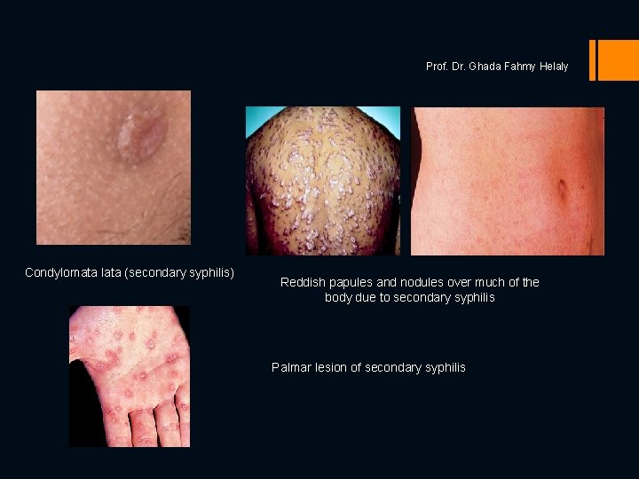 Prof. Dr. Ghada Fahmy Helaly Condylomata lata (secondary syphilis) Reddish papules and nodules over