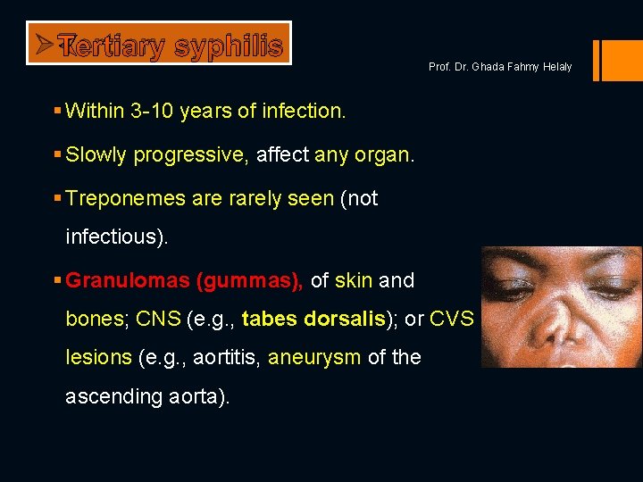 Ø Tertiary syphilis Prof. Dr. Ghada Fahmy Helaly § Within 3 -10 years of