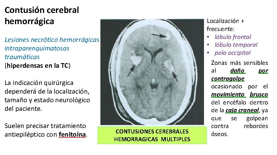 Contusión cerebral hemorrágica Localización + frecuente: • lóbulo frontal • lóbulo temporal • polo