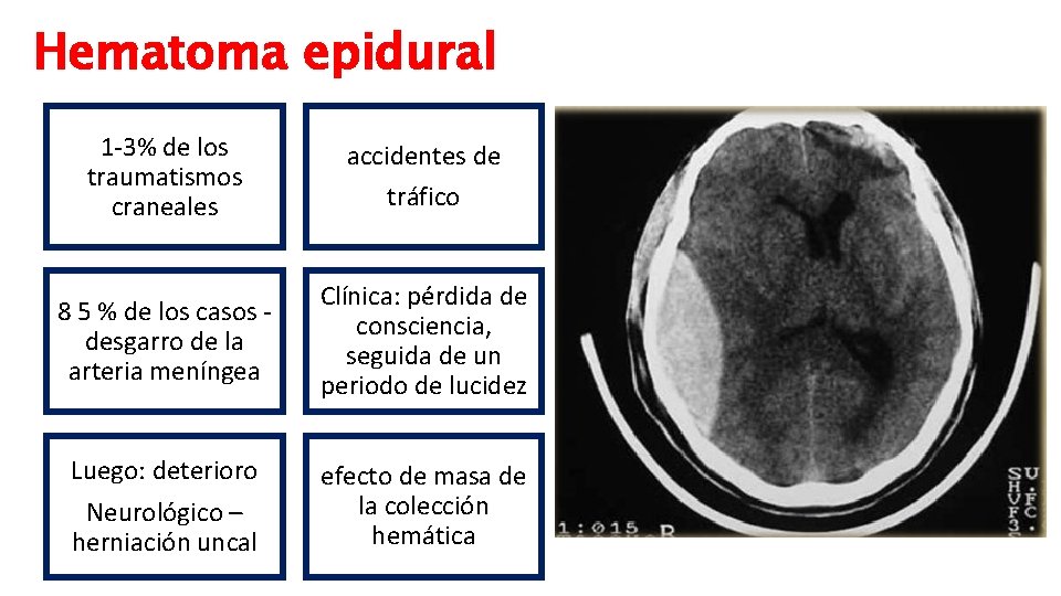 Hematoma epidural 1 -3% de los traumatismos craneales accidentes de tráfico 8 5 %