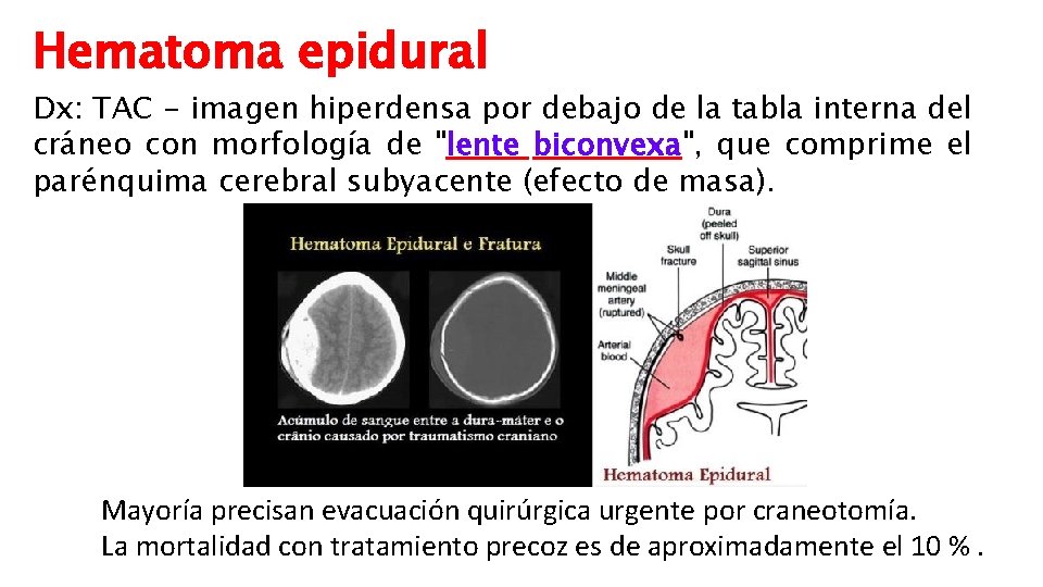 Hematoma epidural Dx: TAC - imagen hiperdensa por debajo de la tabla interna del