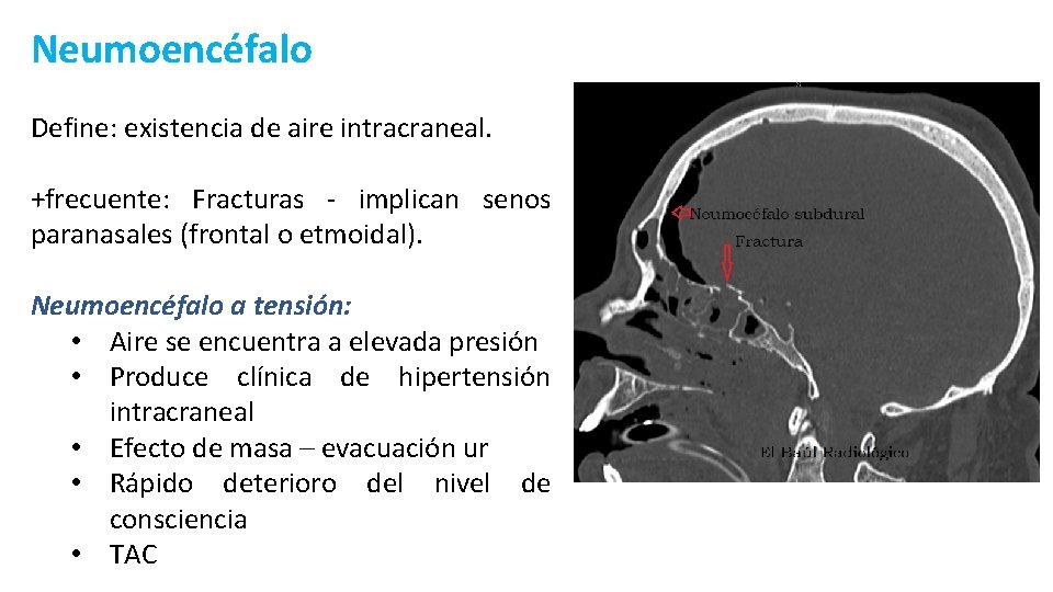 Neumoencéfalo Define: existencia de aire intracraneal. +frecuente: Fracturas - implican senos paranasales (frontal o
