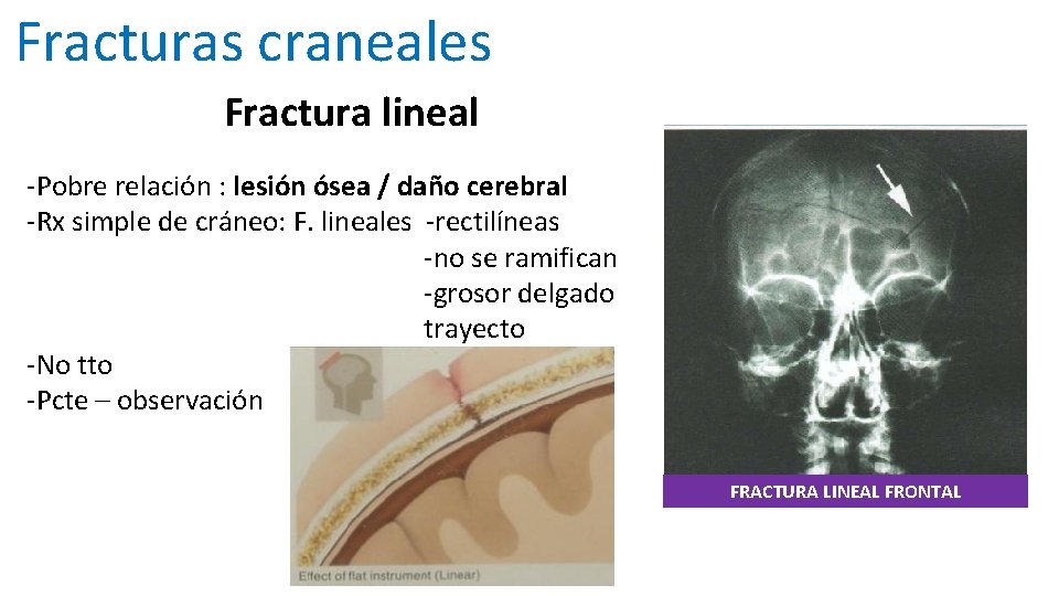 Fracturas craneales Fractura lineal -Pobre relación : lesión ósea / daño cerebral -Rx simple