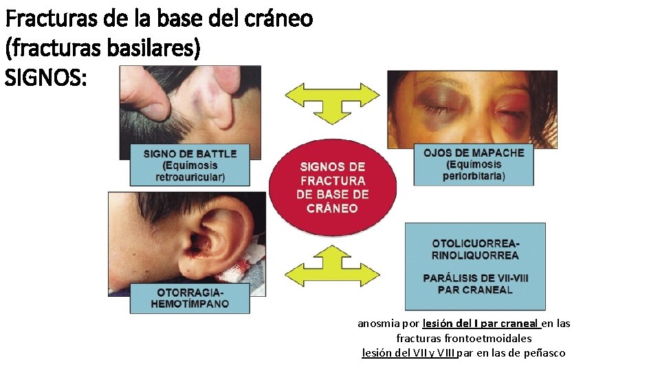 Fracturas de la base del cráneo (fracturas basilares) SIGNOS: anosmia por lesión del I