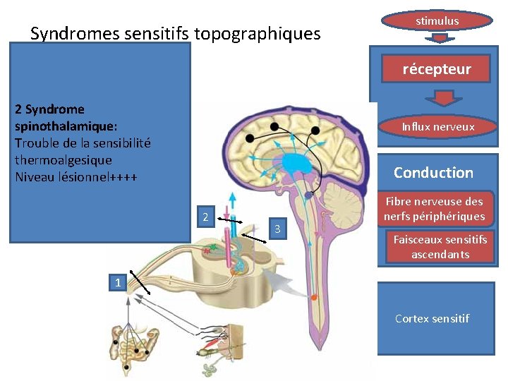 Syndromes sensitifs topographiques stimulus récepteur 2 Syndrome spinothalamique: Trouble de la sensibilité thermoalgesique Niveau