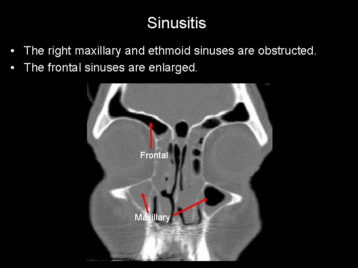 Sinusitis • The right maxillary and ethmoid sinuses are obstructed. • The frontal sinuses