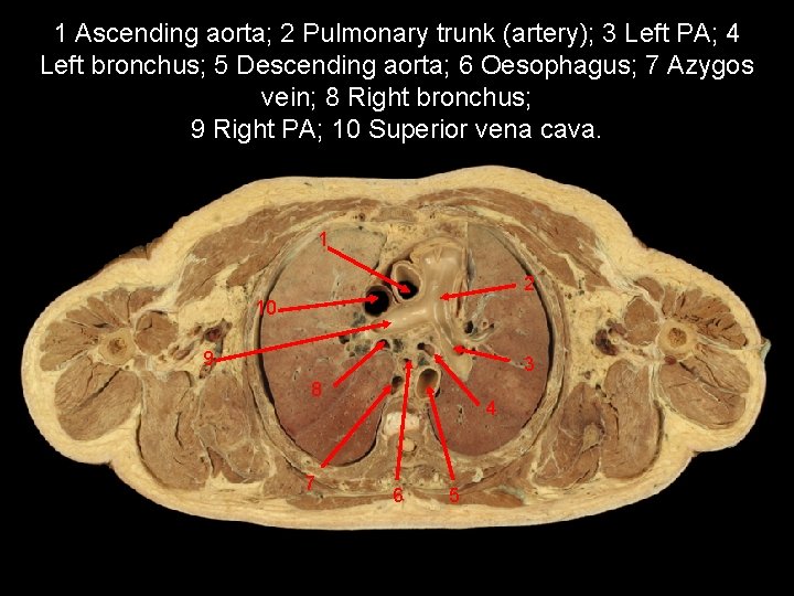 1 Ascending aorta; 2 Pulmonary trunk (artery); 3 Left PA; 4 Left bronchus; 5