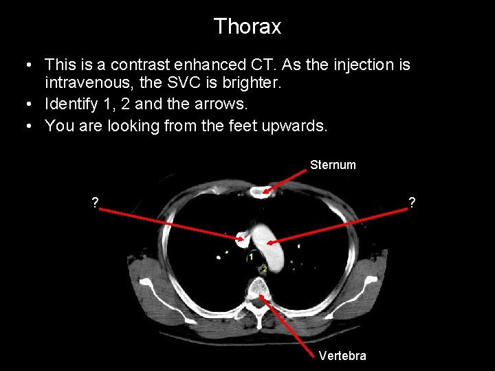 Thorax • This is a contrast enhanced CT. As the injection is intravenous, the