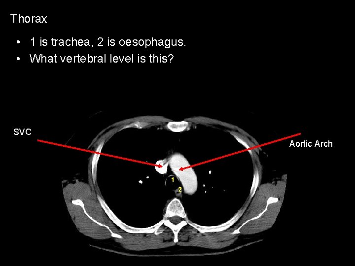 Thorax • 1 is trachea, 2 is oesophagus. • What vertebral level is this?