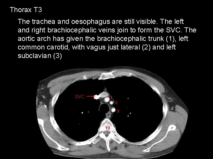 Thorax T 3 The trachea and oesophagus are still visible. The left and right