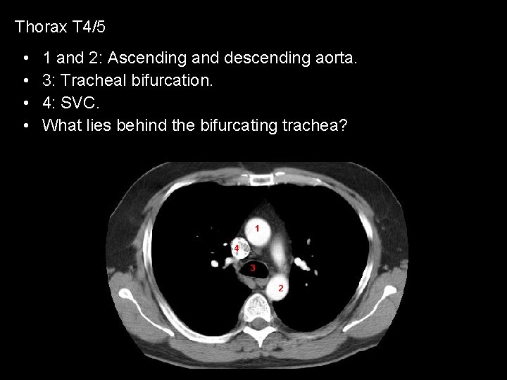 Thorax T 4/5 • • 1 and 2: Ascending and descending aorta. 3: Tracheal