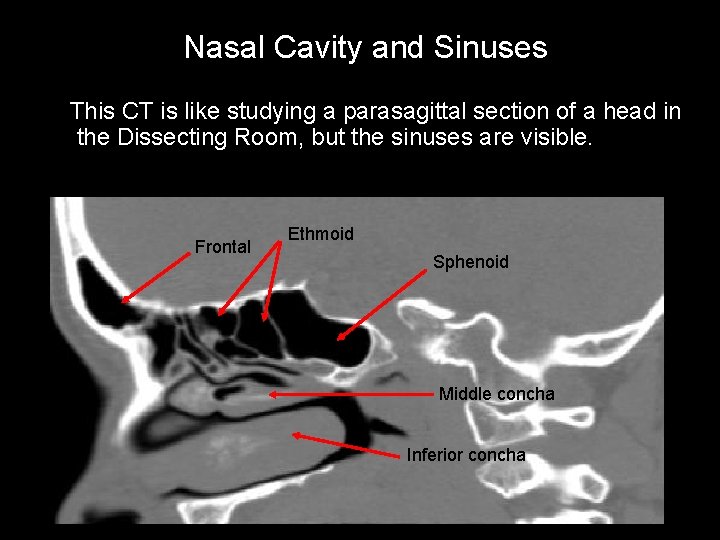 Nasal Cavity and Sinuses This CT is like studying a parasagittal section of a