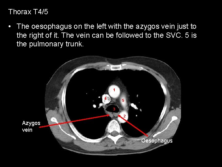 Thorax T 4/5 • The oesophagus on the left with the azygos vein just