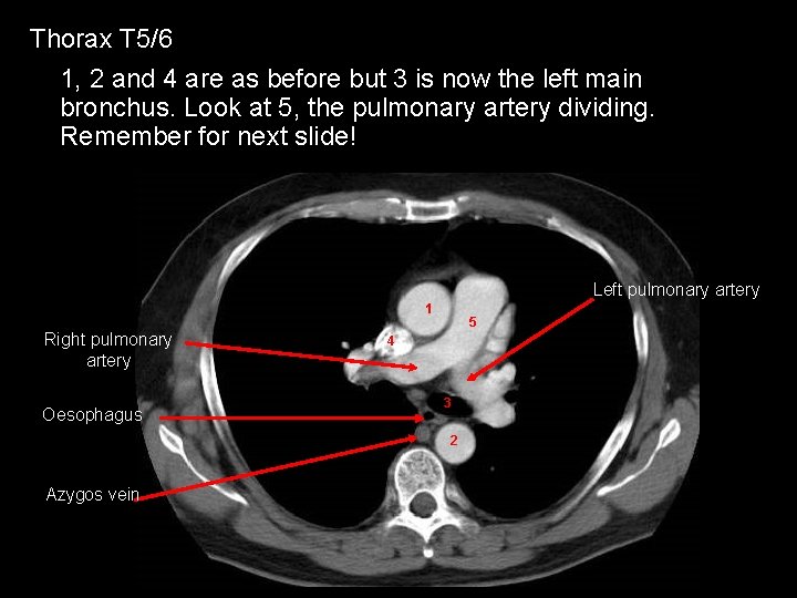 Thorax T 5/6 1, 2 and 4 are as before but 3 is now