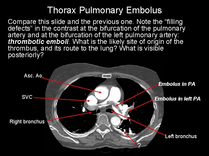 Thorax Pulmonary Embolus Compare this slide and the previous one. Note the “filling defects”