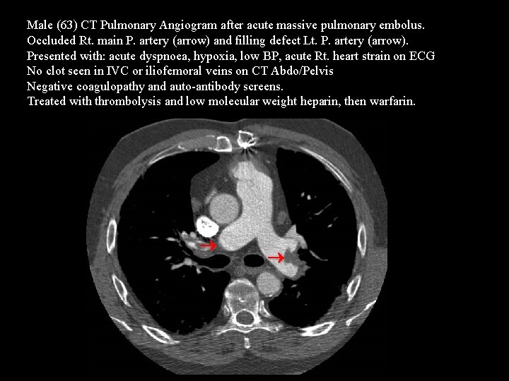 Male (63) CT Pulmonary Angiogram after acute massive pulmonary embolus. Occluded Rt. main P.