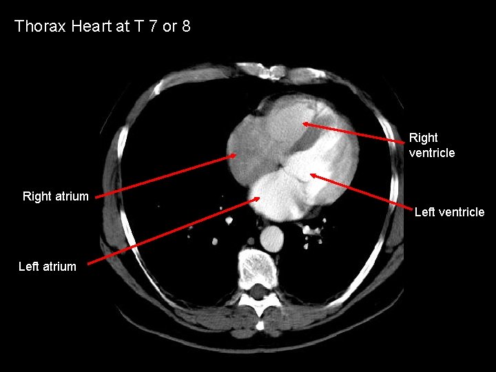 Thorax Heart at T 7 or 8 Right ventricle Right atrium Left ventricle Left