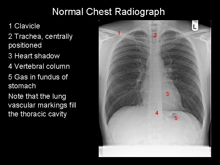 Normal Chest Radiograph 1 Clavicle 2 Trachea, centrally positioned 3 Heart shadow 4 Vertebral