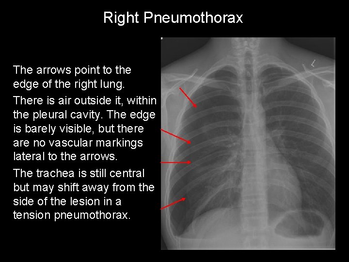 Right Pneumothorax The arrows point to the edge of the right lung. There is
