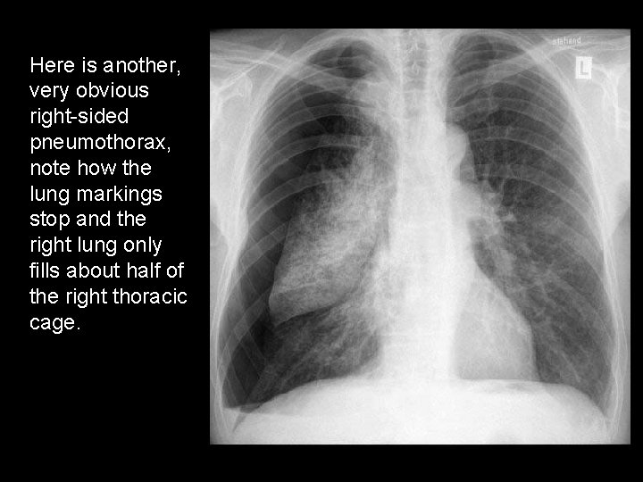 Here is another, very obvious right-sided pneumothorax, note how the lung markings stop and