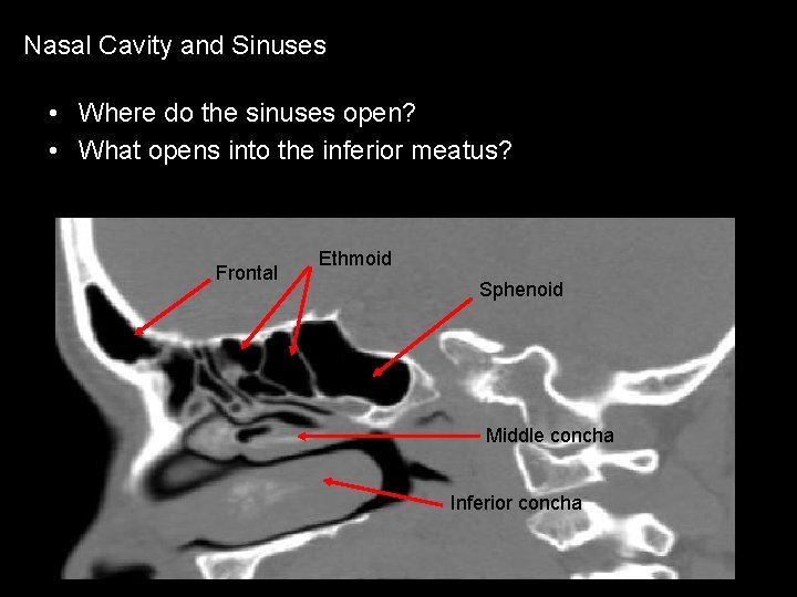 Nasal Cavity and Sinuses • Where do the sinuses open? • What opens into