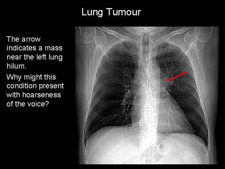 Lung Tumour The arrow indicates a mass near the left lung hilum. Why might
