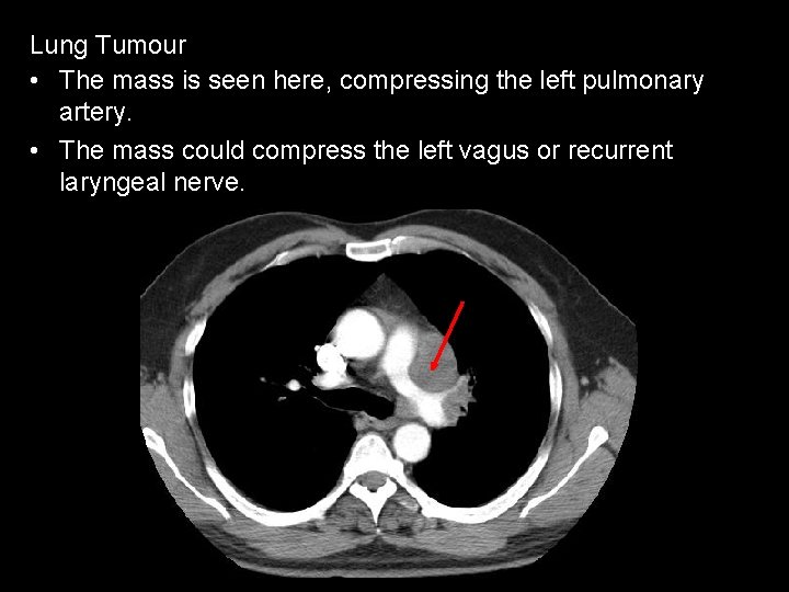 Lung Tumour • The mass is seen here, compressing the left pulmonary artery. •