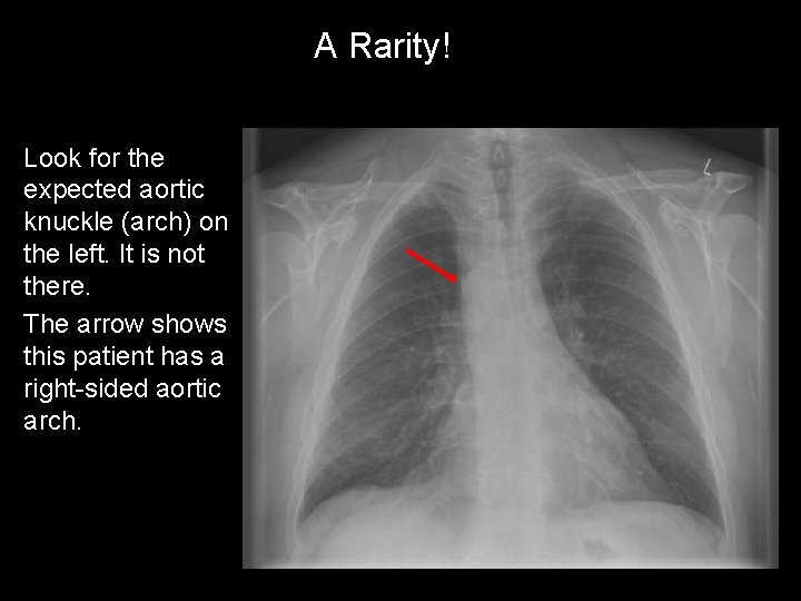 A Rarity! Look for the expected aortic knuckle (arch) on the left. It is
