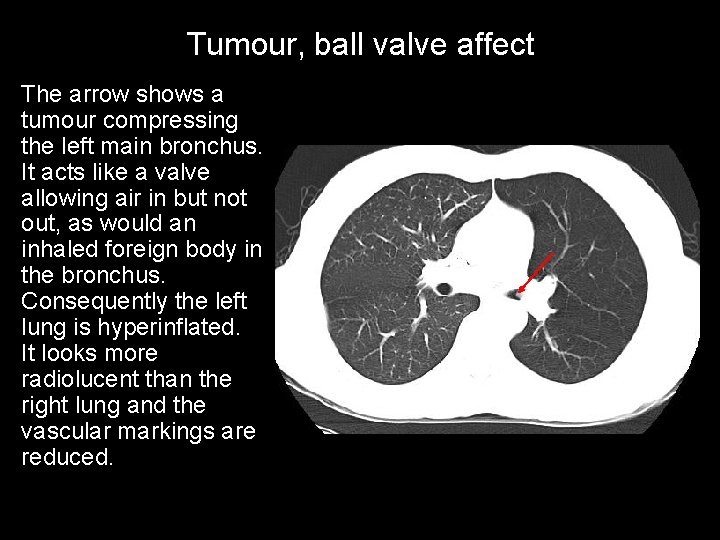 Tumour, ball valve affect The arrow shows a tumour compressing the left main bronchus.