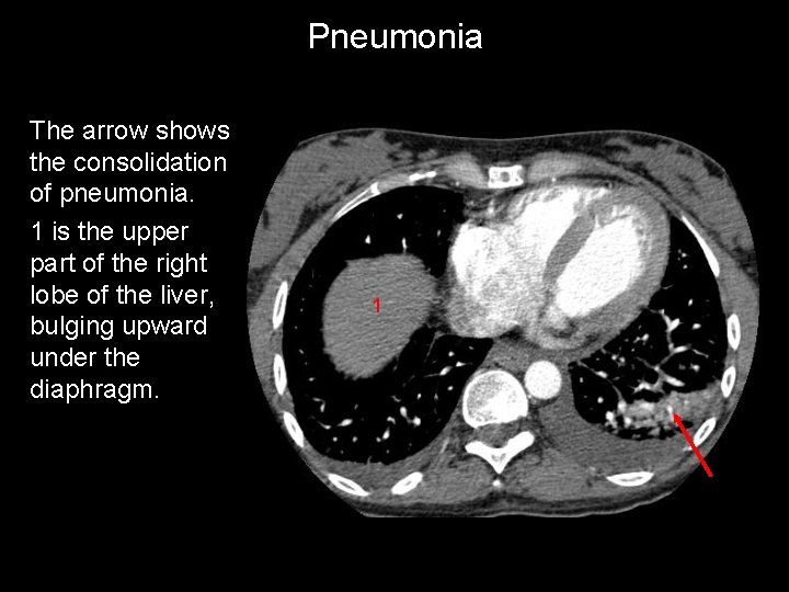 Pneumonia The arrow shows the consolidation of pneumonia. 1 is the upper part of